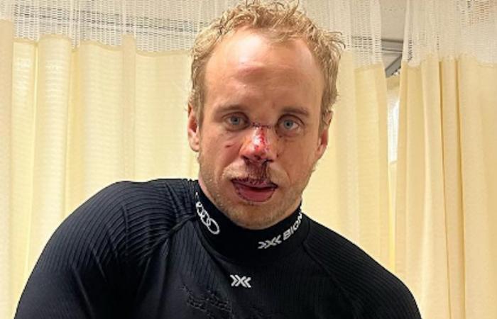 Wild fall! Swiss ski star shows his wounds – winter sports